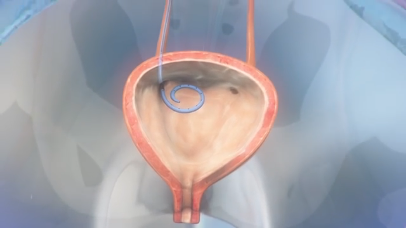 宫腔支架取出过程图片图片