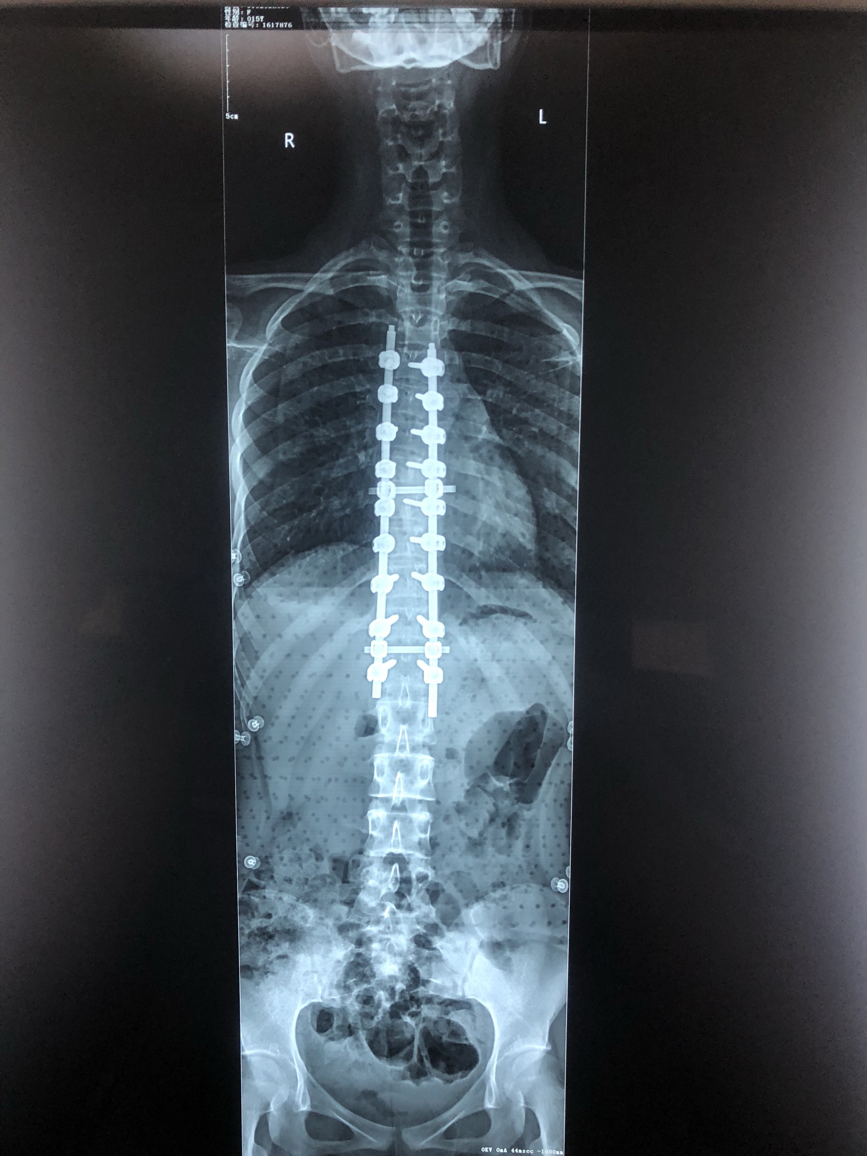 脊柱侧弯手术能彻底治愈么?