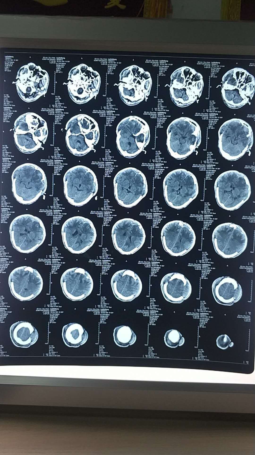醒2-双侧去骨瓣减压术后,意识恢复开微创手术 - 好大夫在线