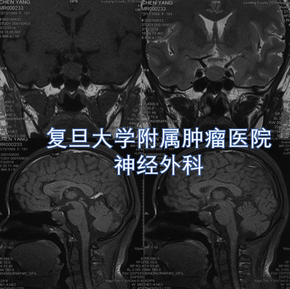 經鼻微創手術切除垂體瘤幫大學生擺脫生活困擾