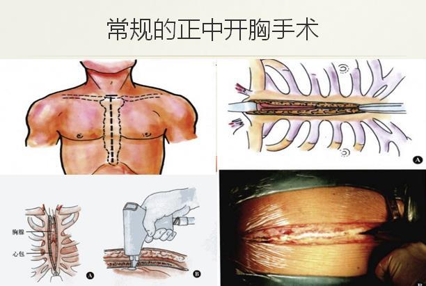 圖2 常規正中開胸冠脈搭橋手術切口