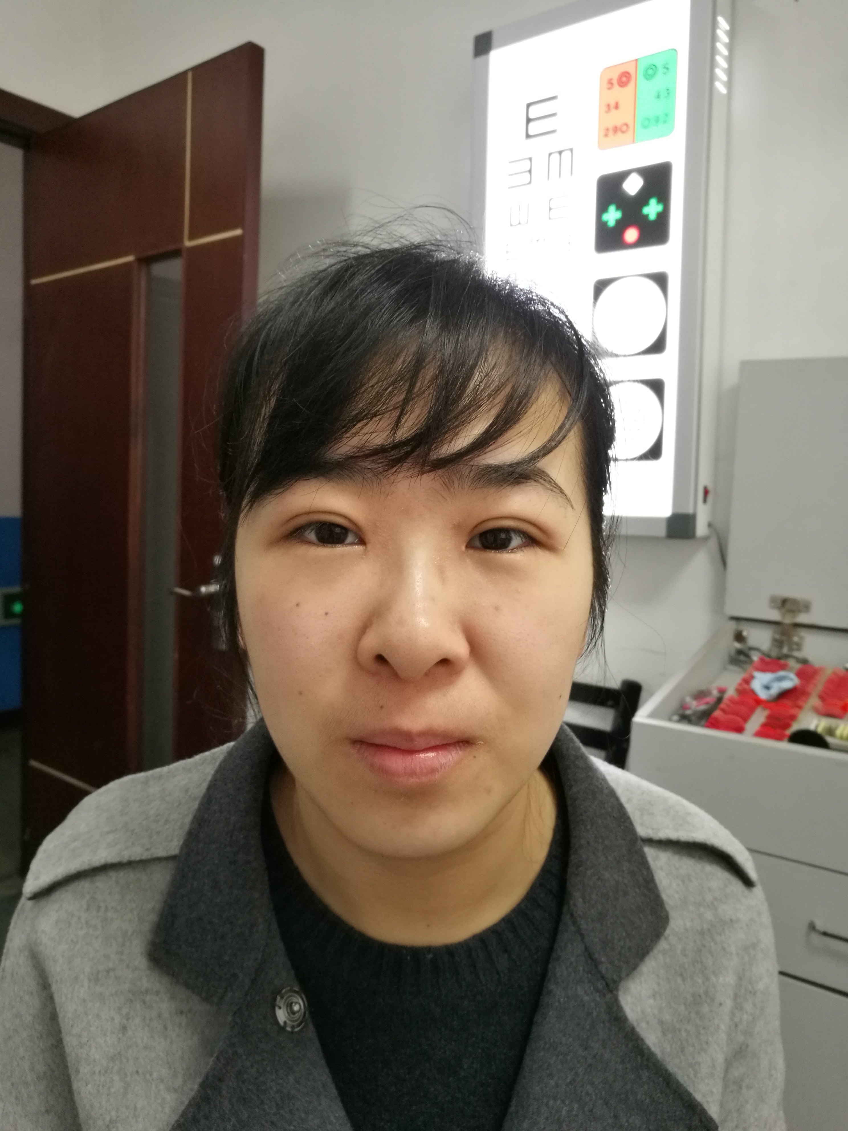 双眼皮修复价格_大连双眼皮的修复_上海修复双眼皮的医生