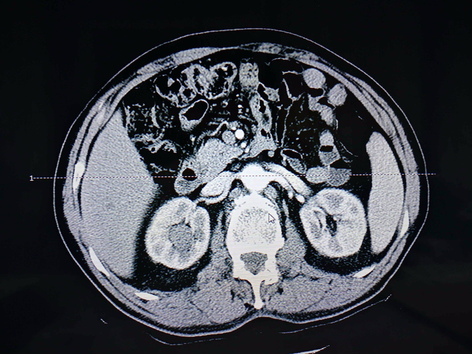 根治術(右側)右側腎乳頭狀癌 腹腔鏡腎癌根治術(右側)左側巨大錯構瘤