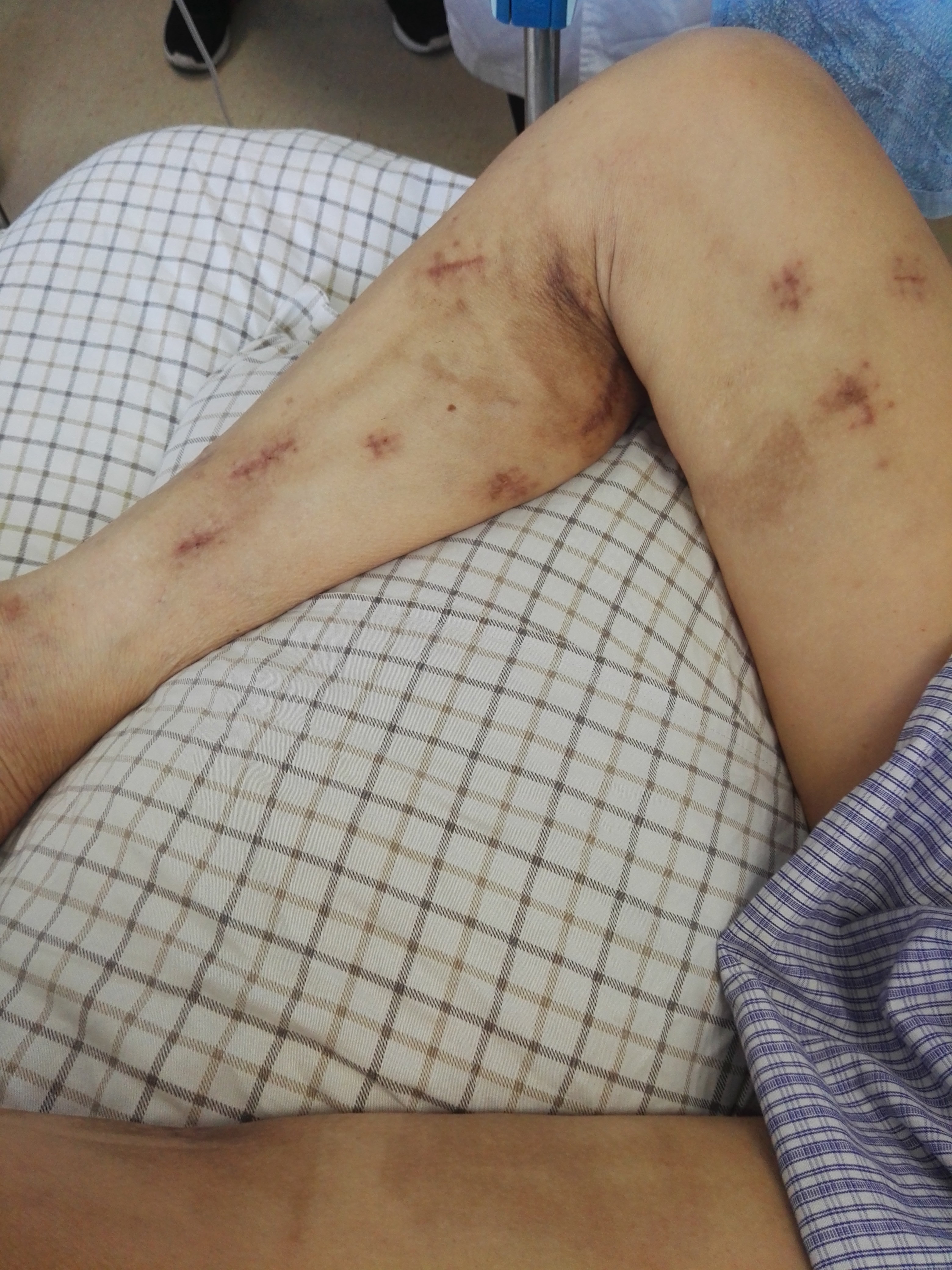 全动脉化不停跳搭桥