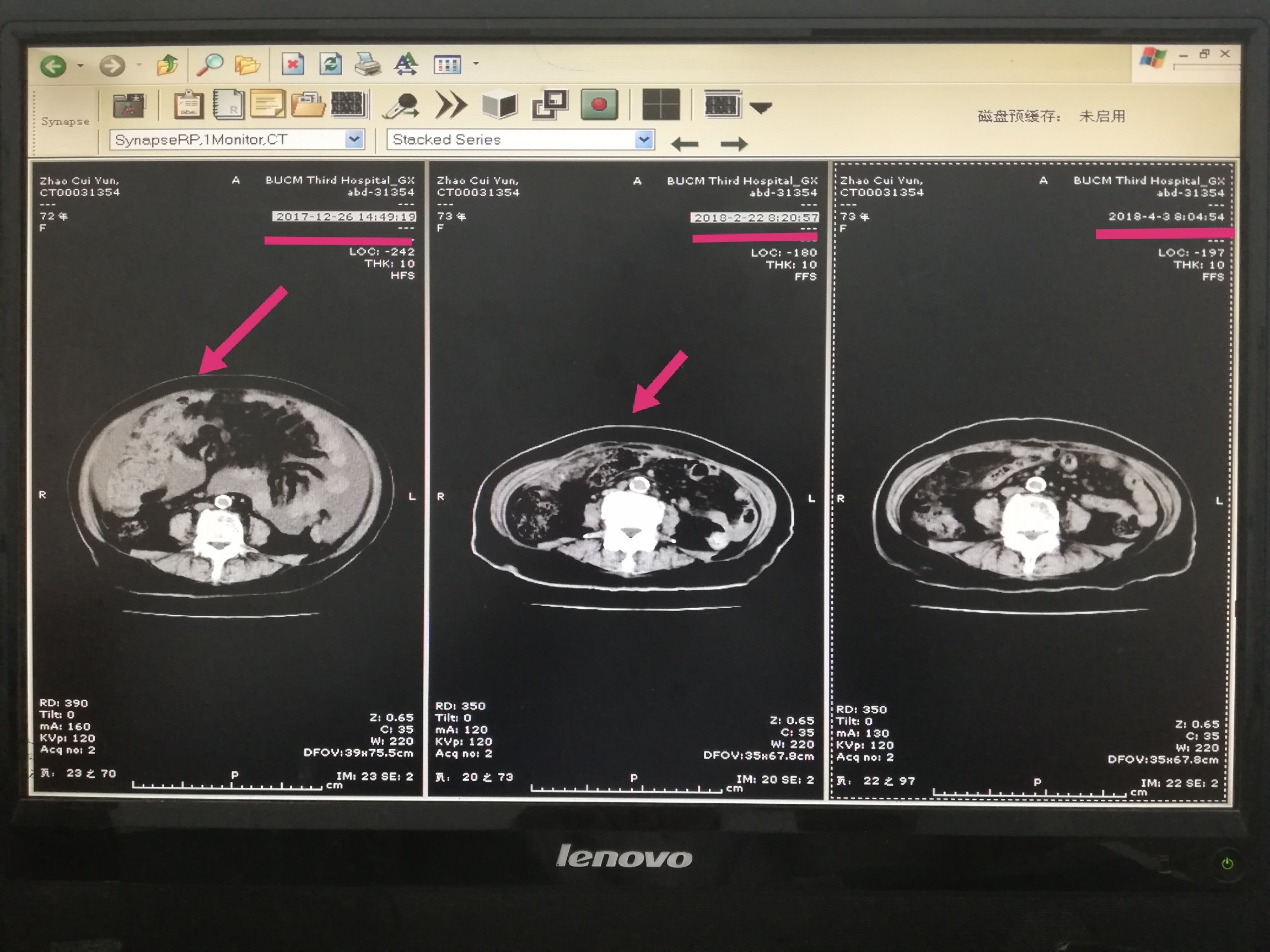 中西医治疗老年晚期卵巢癌至肿瘤影像消失并成功手术1例分享