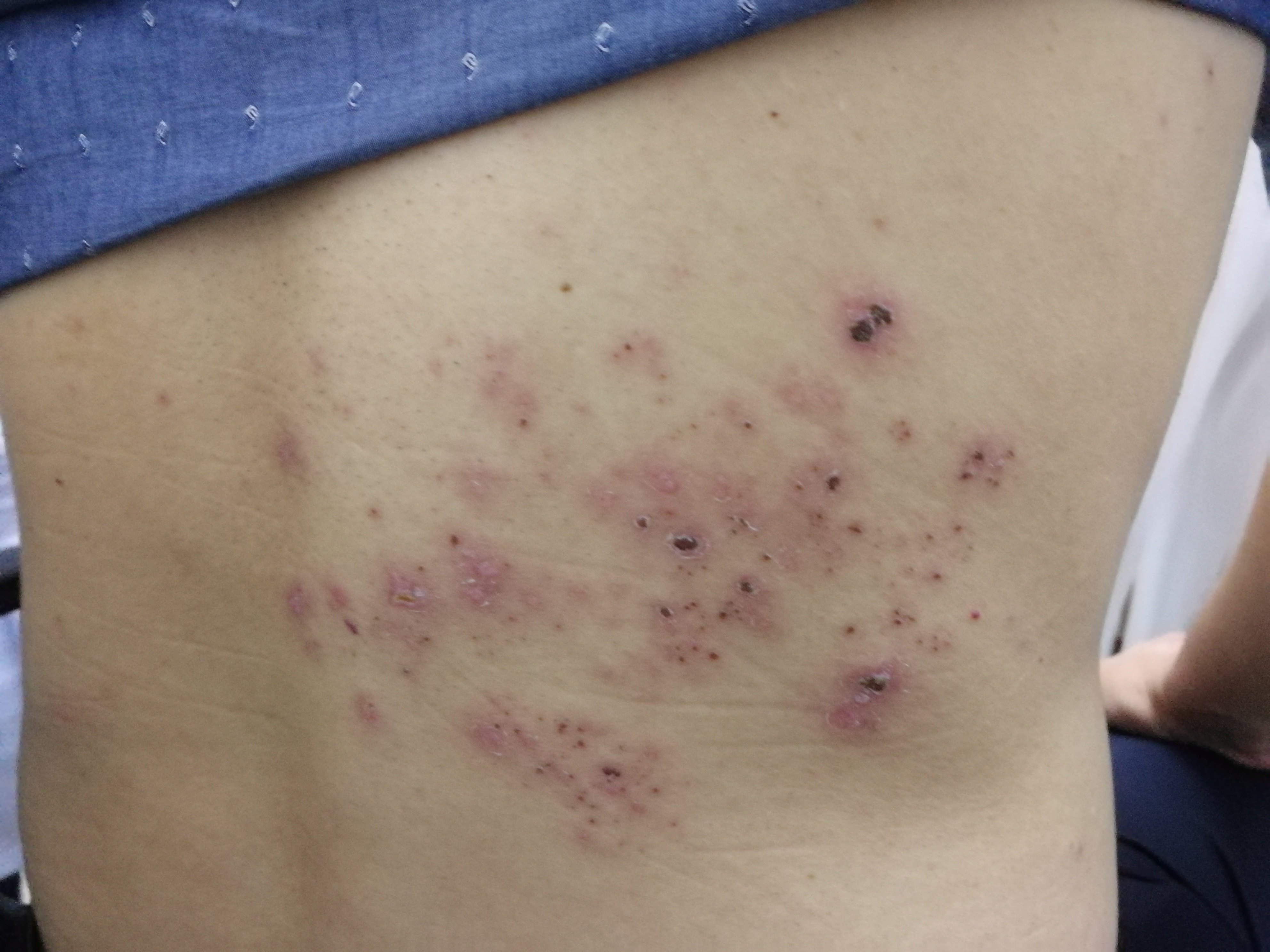 背部带状疱疹早期图片图片