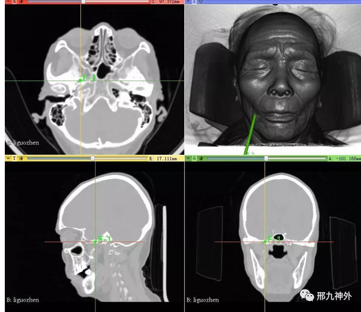 一,术前ct数据三维重建,观察卵圆孔大小形态,模拟穿刺路径,对每位
