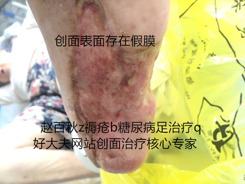 清創後在換藥過程中出現假膜組織,影響肉芽組織生長修復創面,經清除