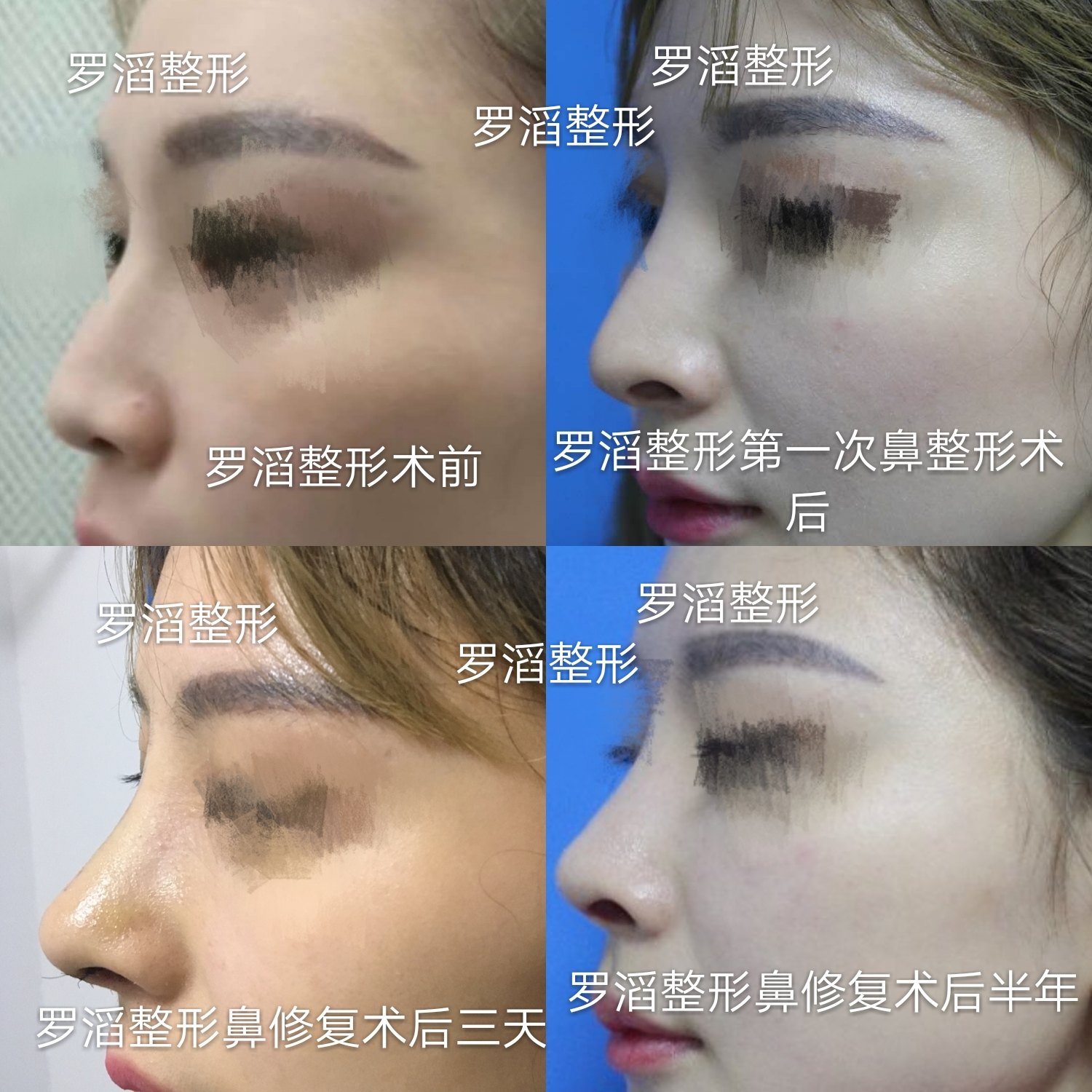 耳软骨修复综合鼻整形 耳软骨修复综合鼻整形