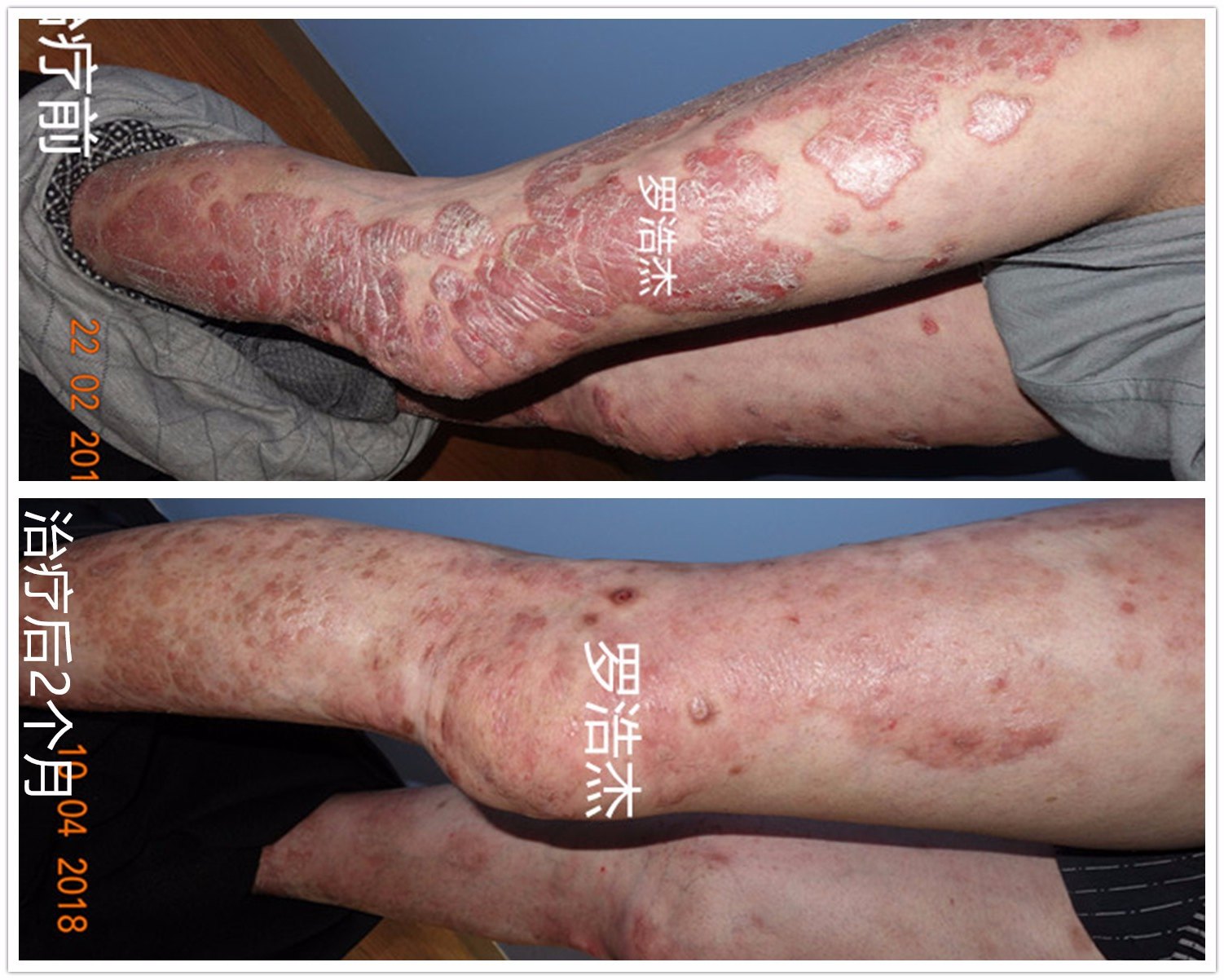 中医中药治疗在银屑病(牛皮癣)治疗上的临床案例_银屑病_中医疗法