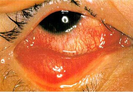 脊髓灰质炎后遗症病理反射_脊髓灰质炎出现并发症多见于_脊髓灰质炎后遗症病人可见