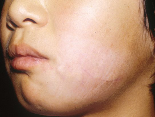 疤痕修复 - 好大夫在线