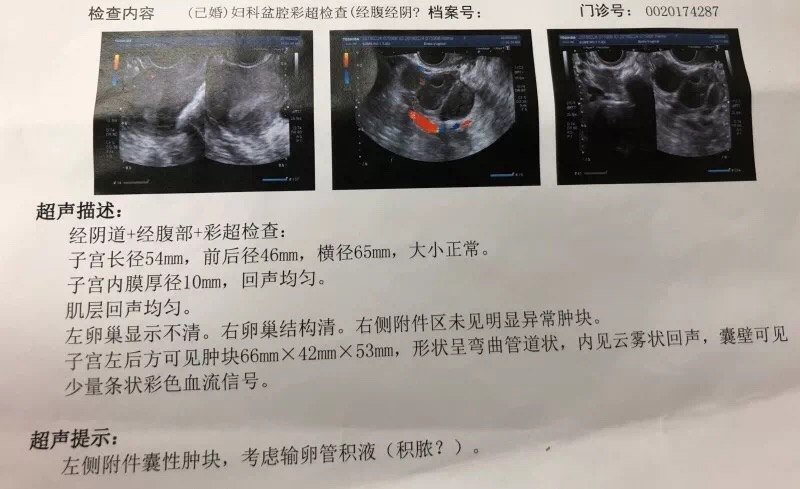 为什么试管前需要处理输卵管积水?
