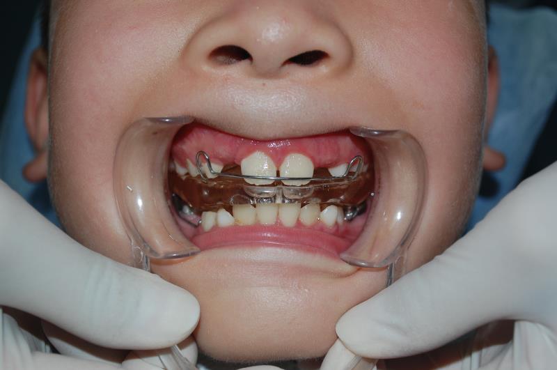 给孩子配一个功能性矫治器,导下颌向前,促进下颌发育