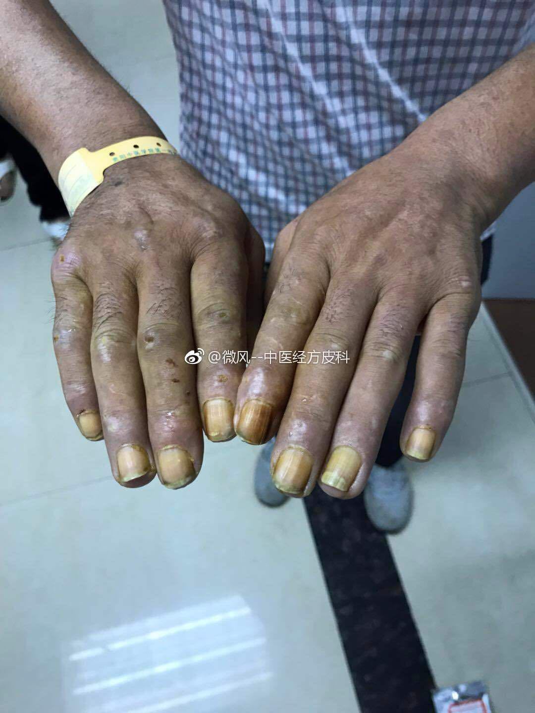 3)皮肌炎或多发性肌炎;2)系统性红斑狼疮;1)全身性硬皮病;皮肤科见于