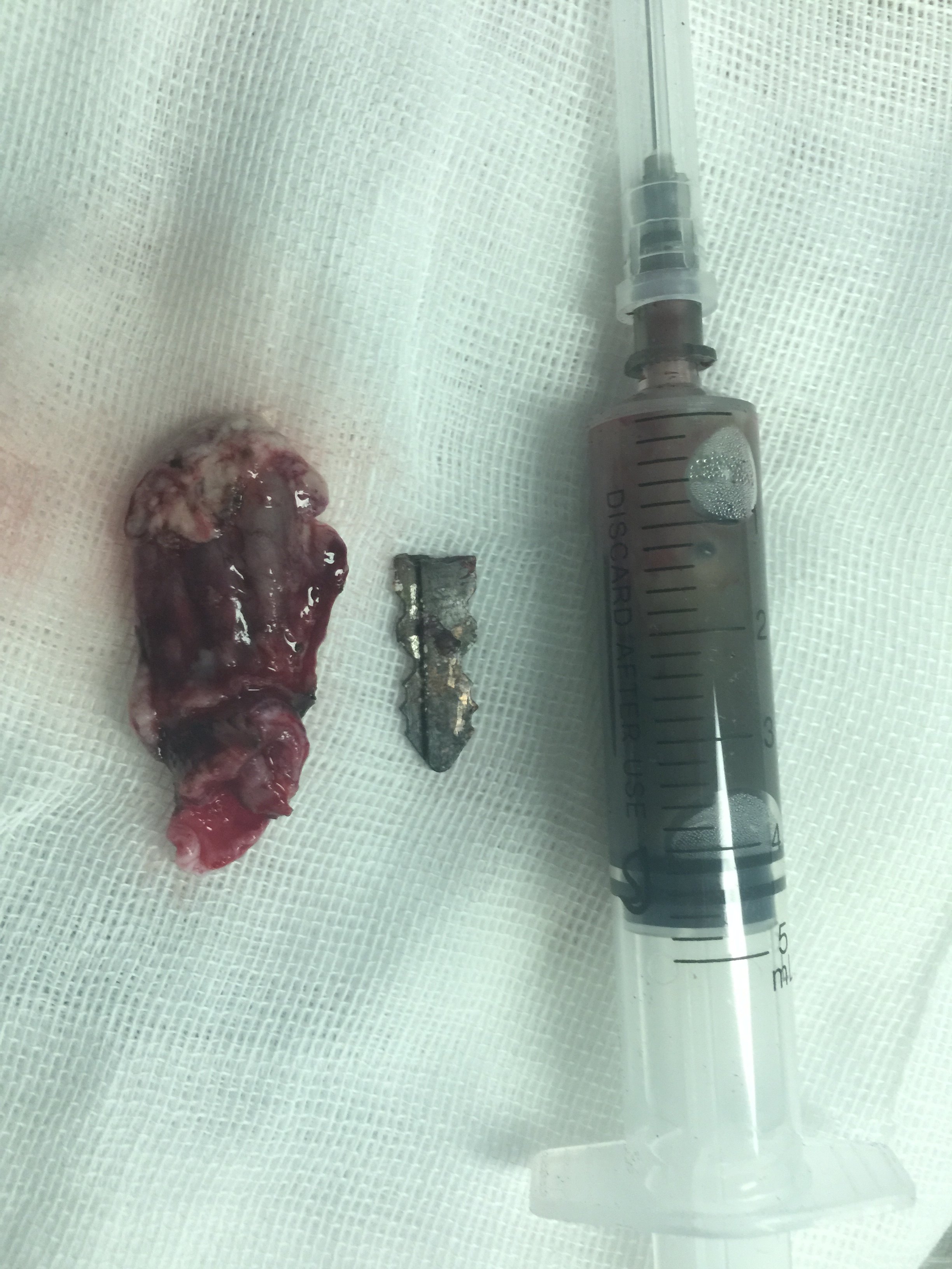 术后取出金属钥匙,抽出脓液,完整切除脓肿