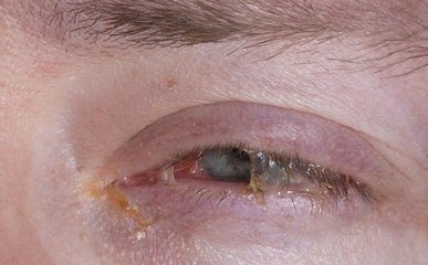 结膜炎 患者中,表现为黏稠白色丝状物质,与常用的胶水性状十分相似