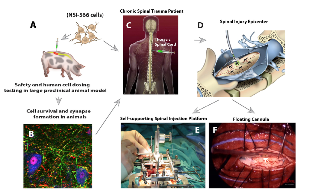干细胞研究里程碑:神经干细胞移植治疗脊髓损