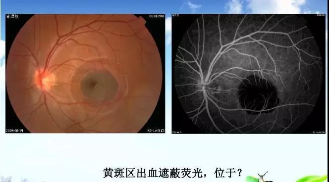 【图文】眼底荧光血管造影