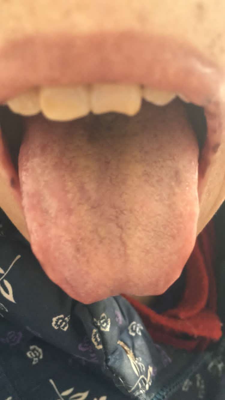 癌症舌苔图片