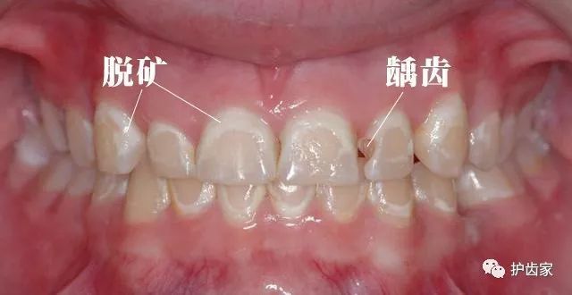 儿童牙齿钙化的原因图片