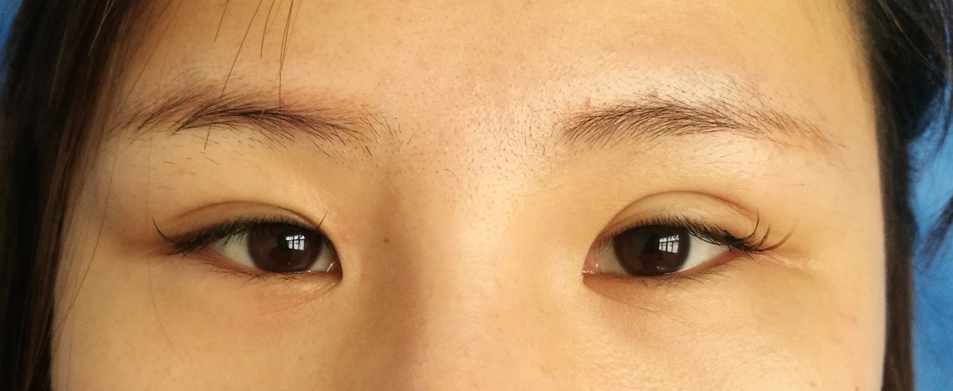 多重技术融合的双眼皮修复术--让失败重睑重