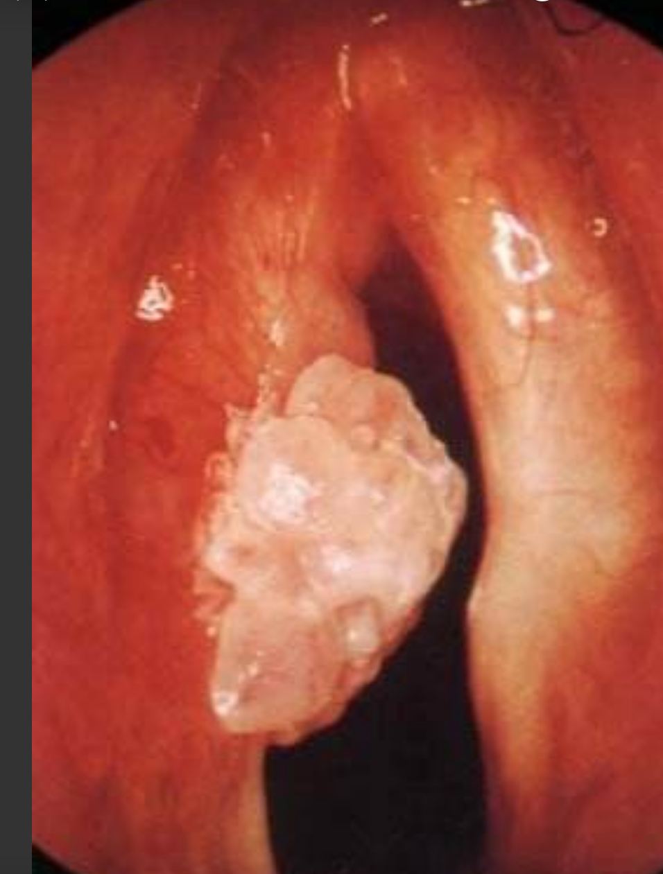 5,喉癌:声嘶进行性加重,随着肿瘤体积增大可致呼吸困难