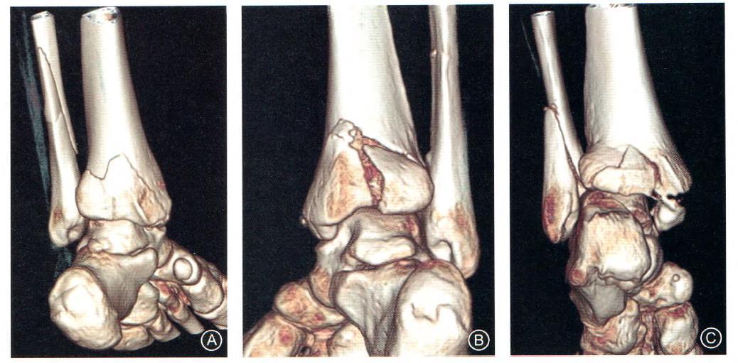 後pilon骨折分型及治療
