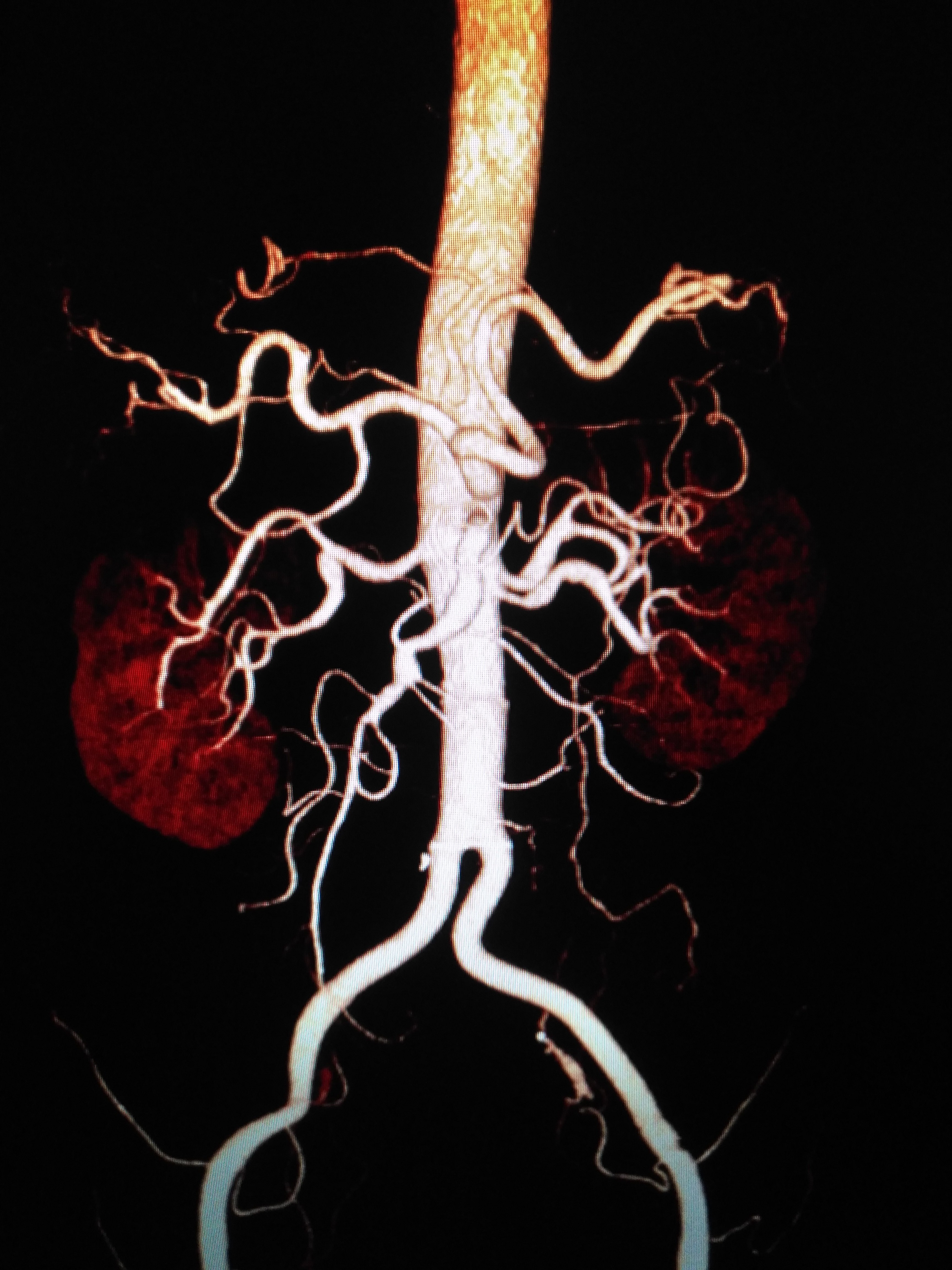 感染性破裂腹主动脉瘤手术治疗