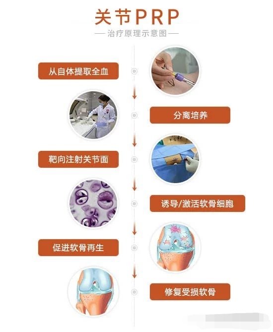 生长因子富血小板血浆prp注射治疗运动损伤