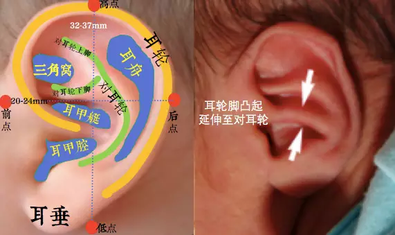 重視寶寶耳廓畸形的早期發現及治療