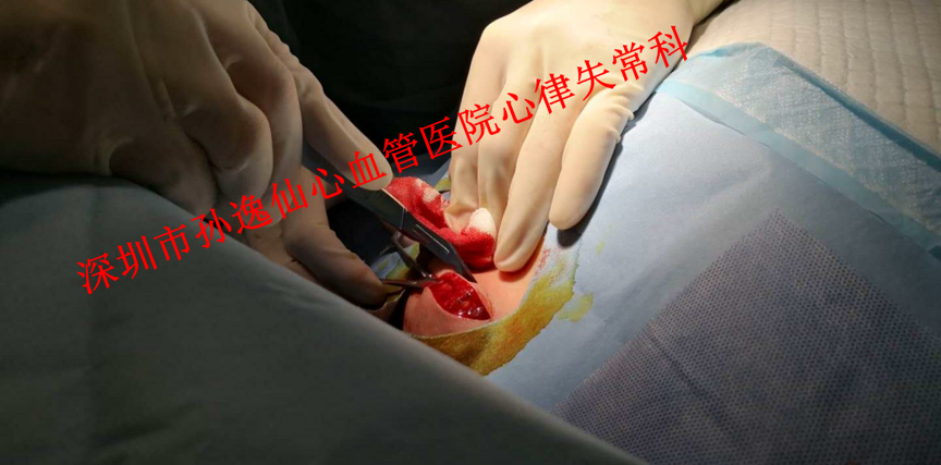 临时起搏器植入术图片