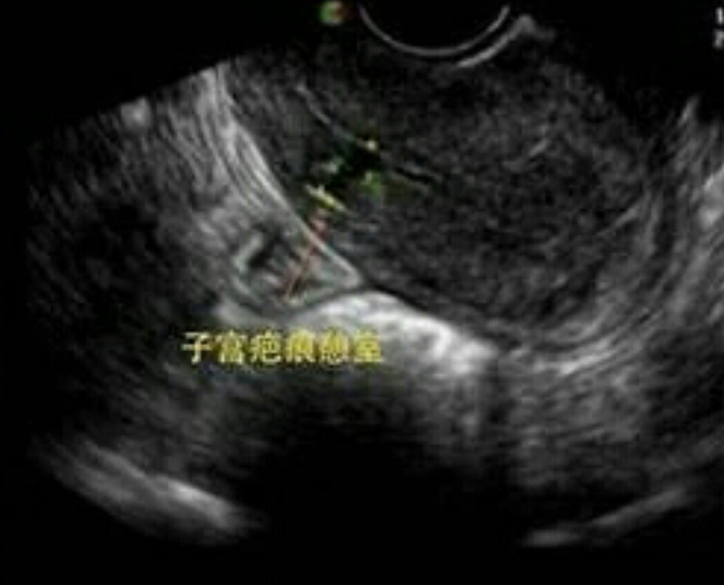 子宫瘢痕憩室 - 好大夫在线