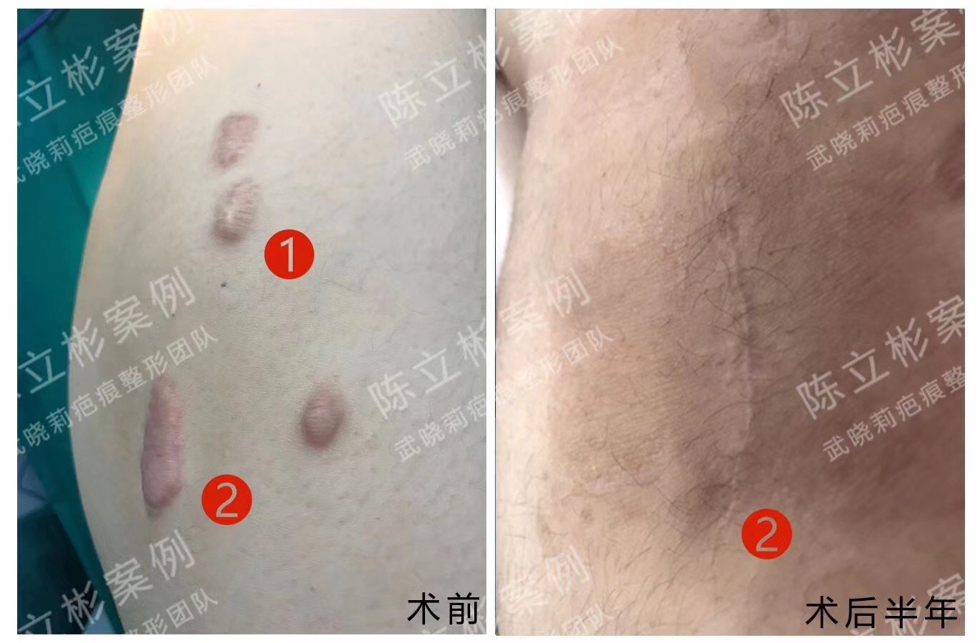 大腿疤痕疙瘩#切除#减张精细缝合# ,术后配合放疗,#减张护理#现恢复近