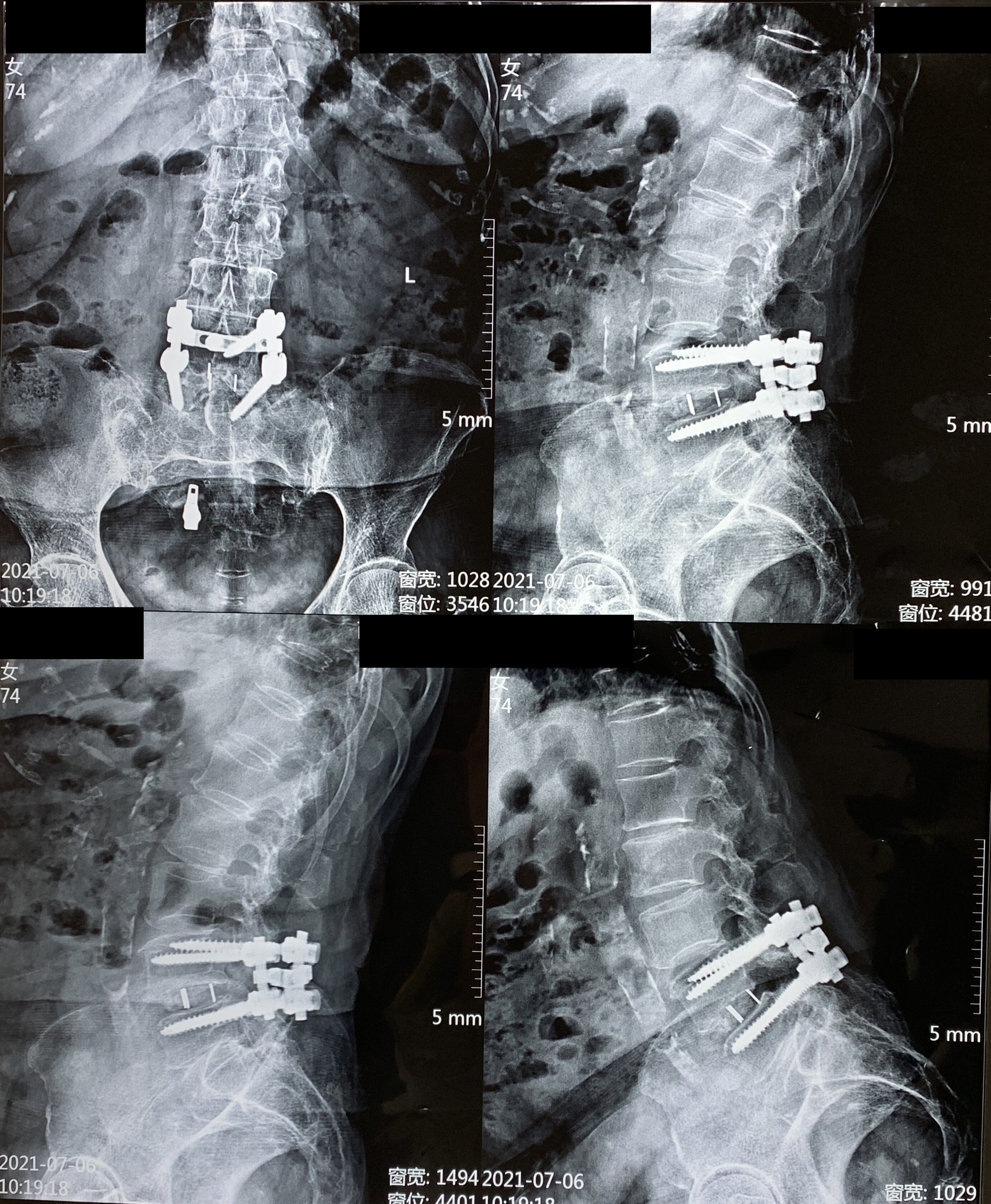 抗骨质疏松症治疗应优先于手术治疗患者做了腰椎手术后疼痛未缓解