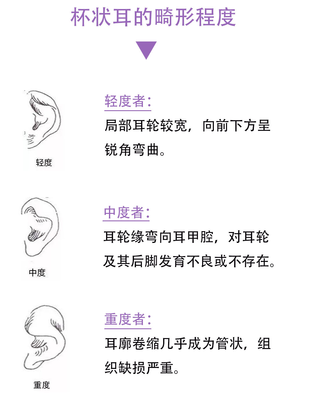 什么是杯状耳?揪揪能不能好?