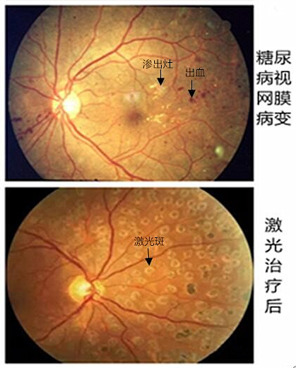 视网膜病_视网膜病治疗方式 - 好大夫在线