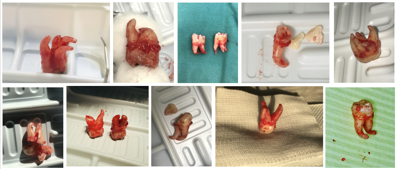 臨床常見的各類複雜智齒及埋伏牙的拔除
