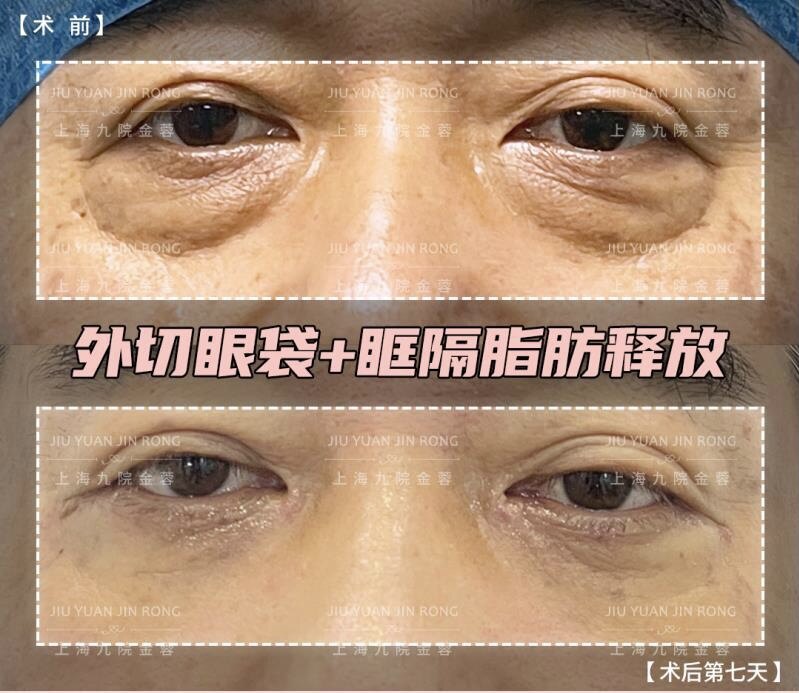 九院金蓉整形案例#外切眼袋 眶隔脂肪释放术后第7天 - 好大夫在线