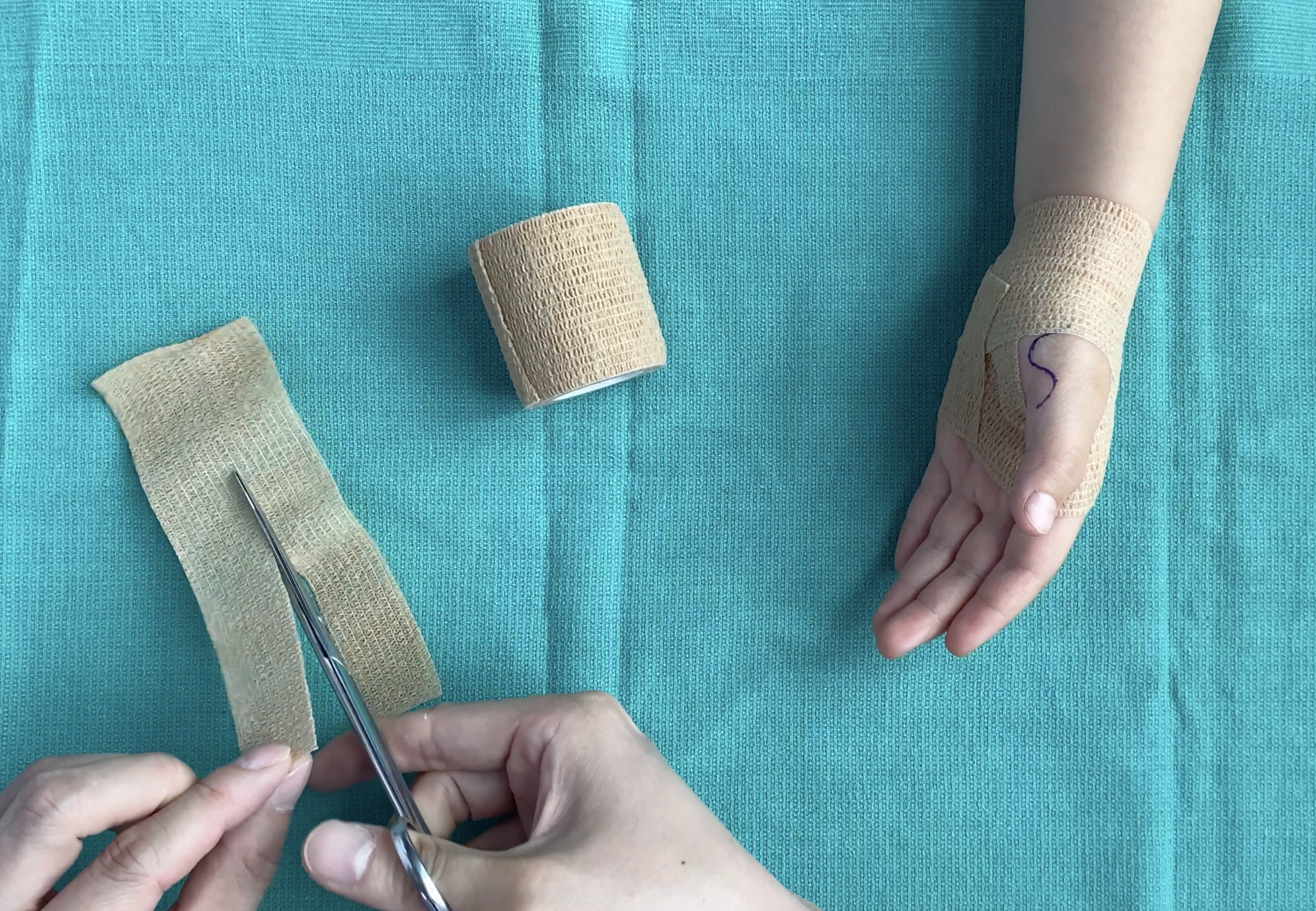 多拇瘢痕一般位于拇指侧方;控制瘢痕有好多种方法,其中使用自粘绷带