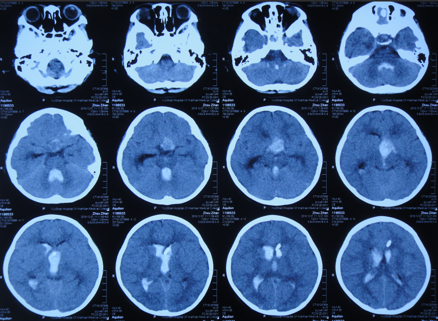 扔掉的ct胶片怎么处理(废弃CT胶片的处理方法) 扔掉的ct胶片怎么处理(废弃CT胶片的处理方法)