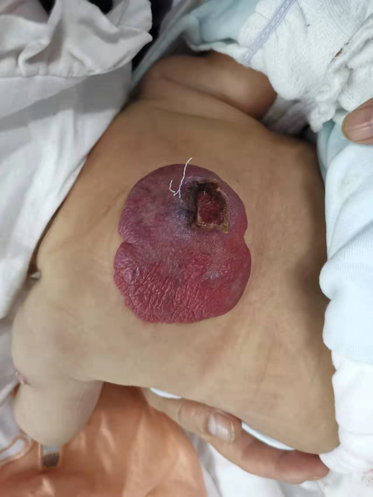 小宝宝血管瘤图片图片