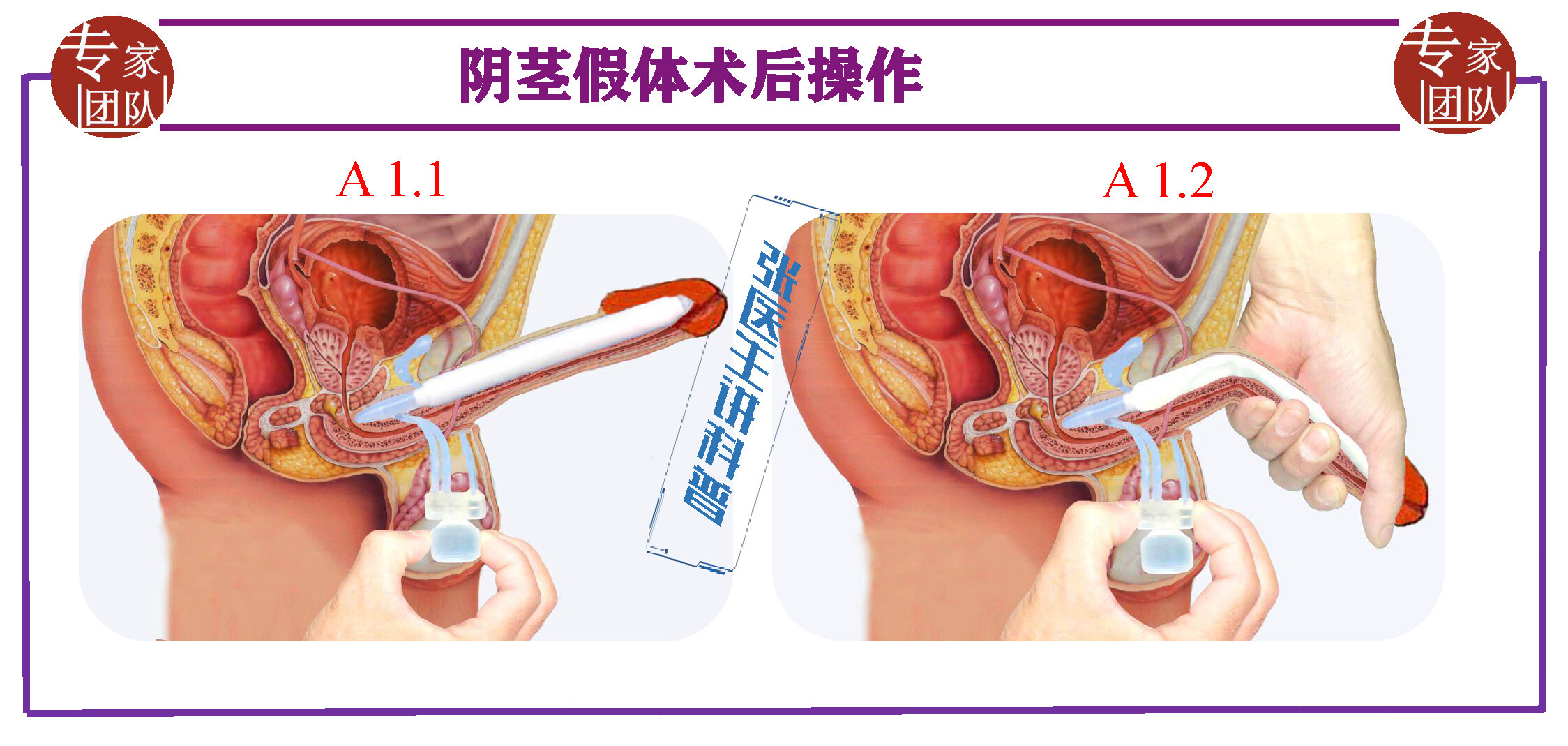 男性植入假体手术图片