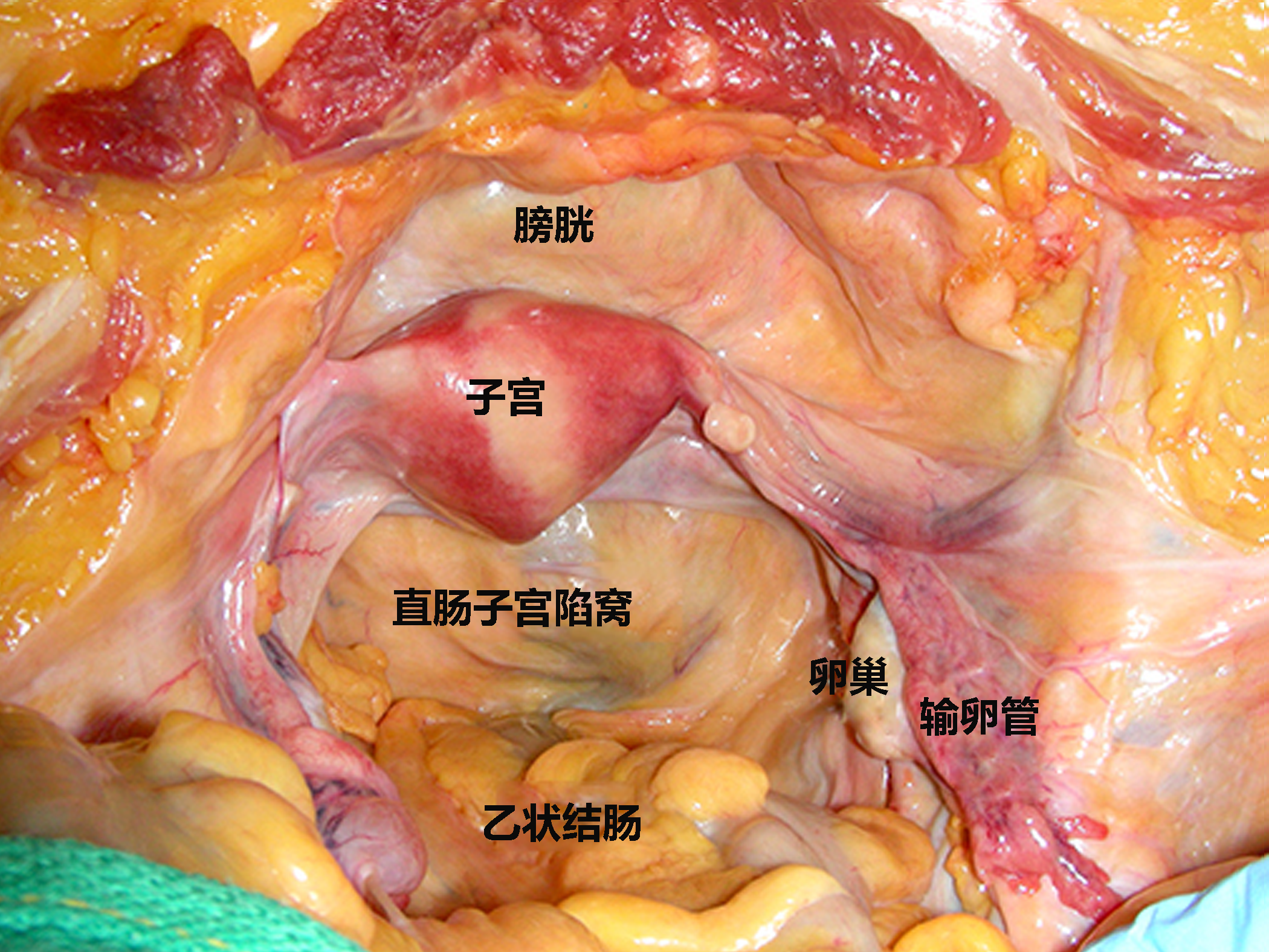 子宫解剖图 立体图图片