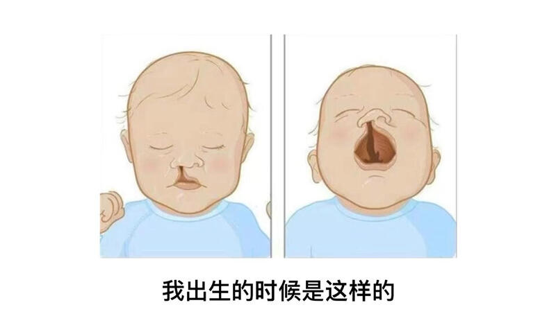 宝宝喉咙腭裂图图片