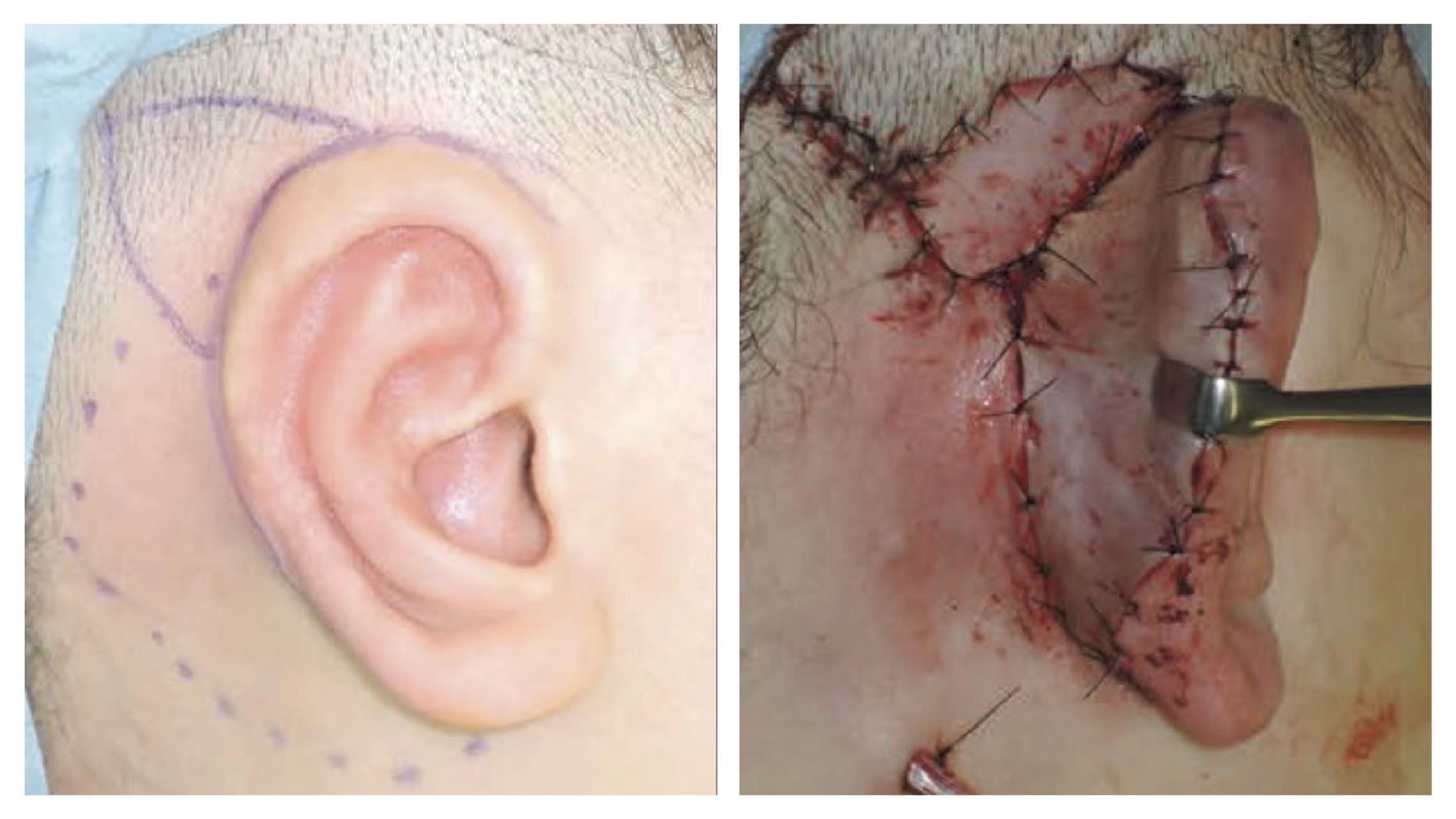 耳朵骨桥手术后图片图片