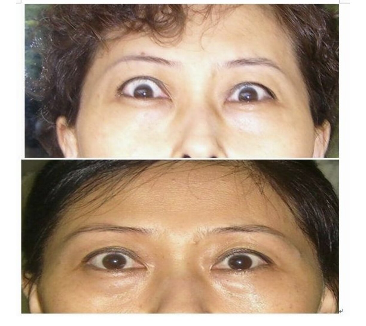 真实案例:甲亢突眼治疗前后对照(43例患者照片)