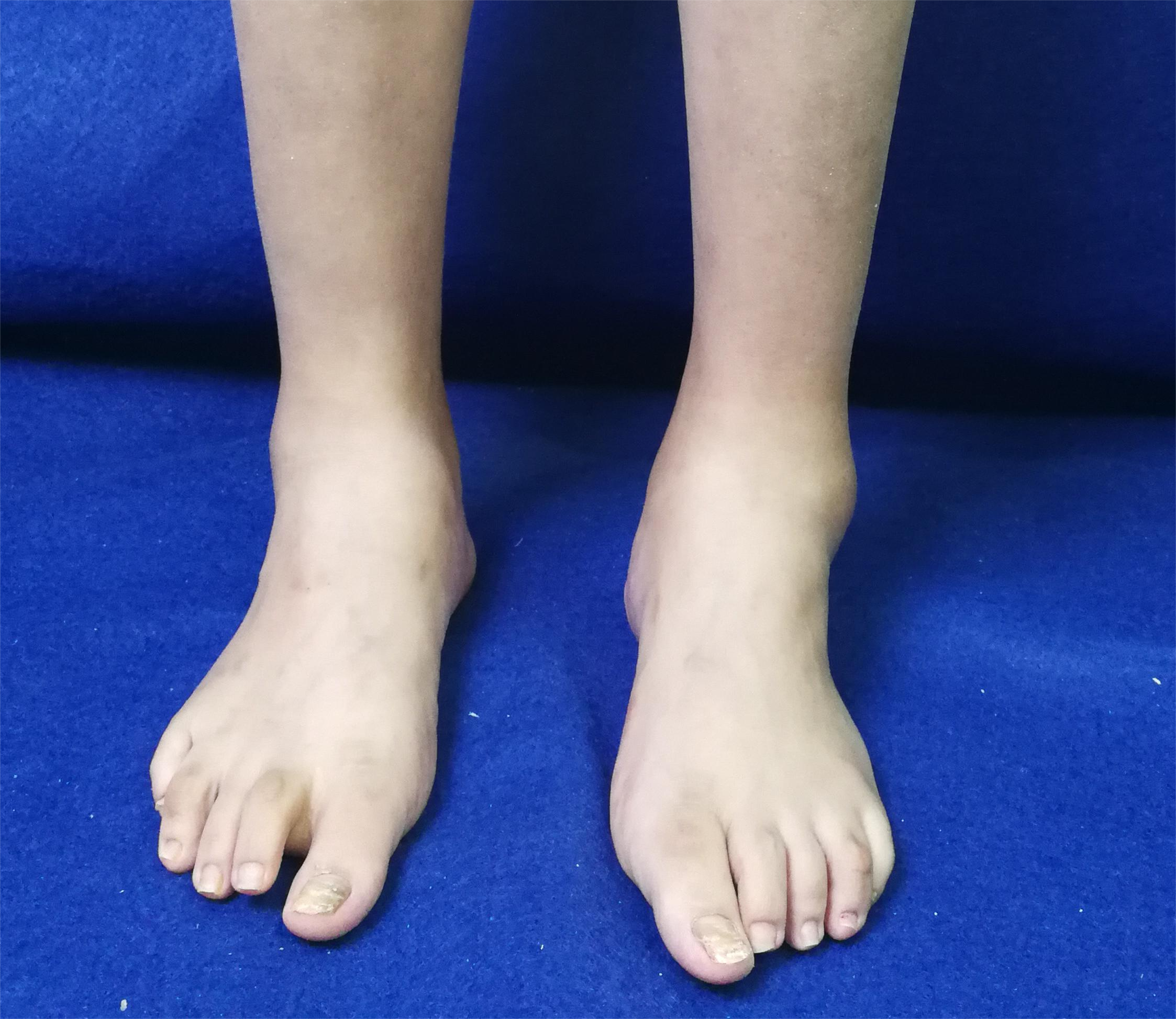 类风湿导致前足畸形踝关节类风湿性关节炎早期表现为踝关节肿胀,疼痛