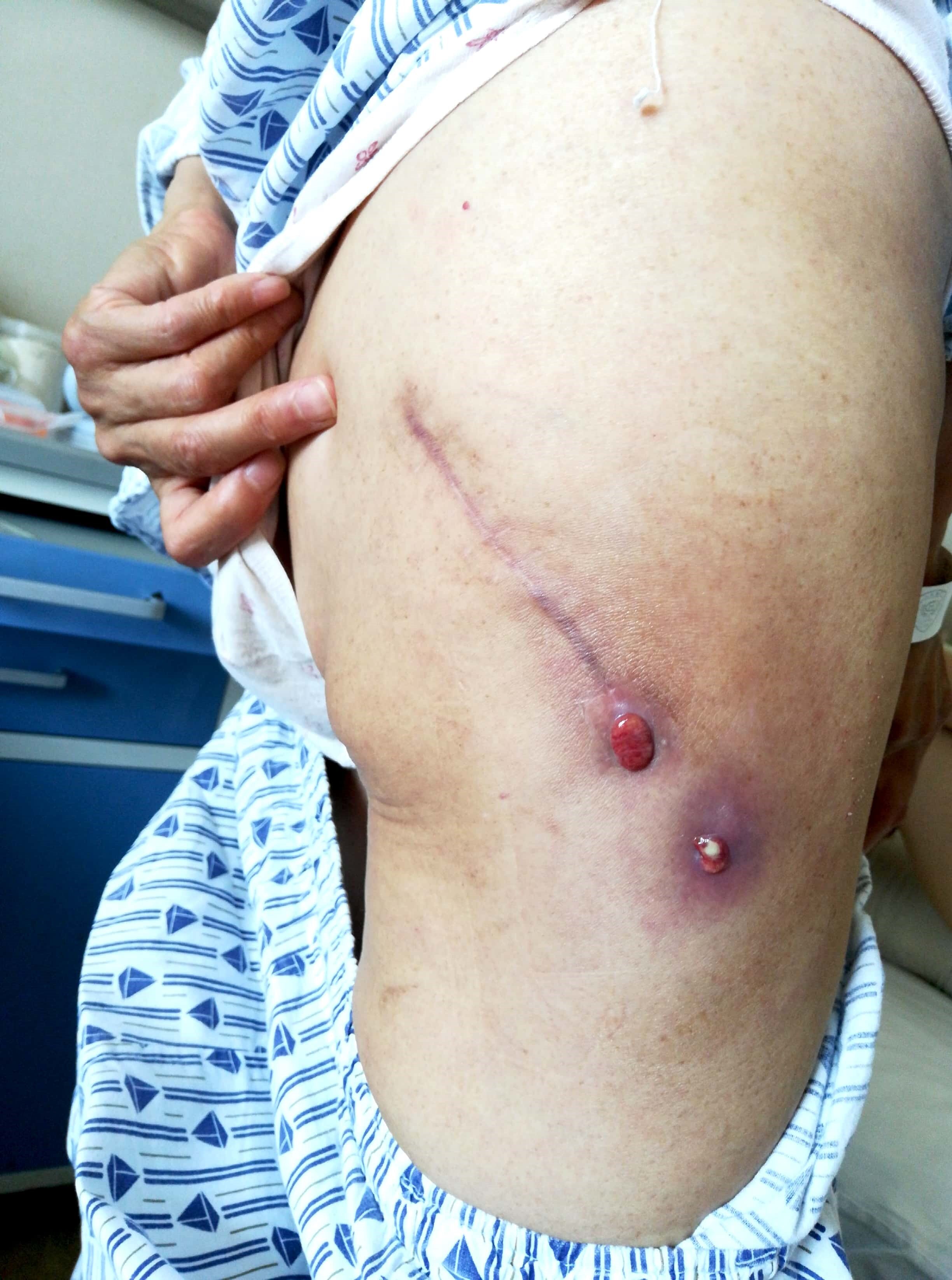 全髋关节置换术,人工股骨头置换术可以美容缝合吗?