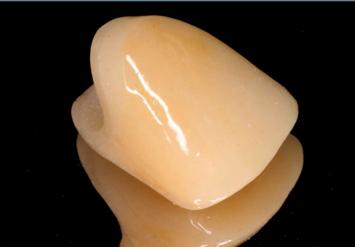 前牙牙冠断裂修复的过程 - 好大夫在线